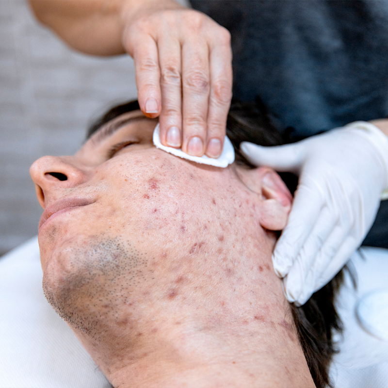 Person receiving facial treatment for acne, close-up view.
