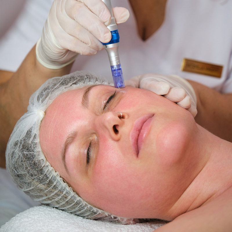 A woman receiving a professional facial treatment with a microneedling device in a spa setting.