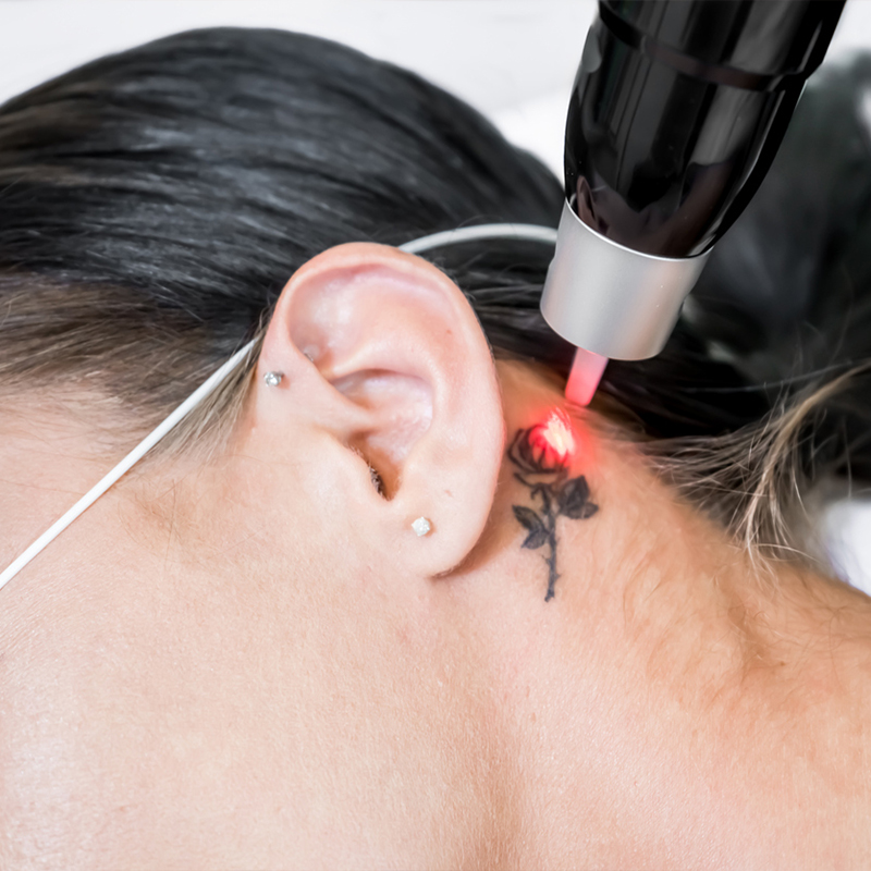Laser removal of a rose tattoo on woman's neck.