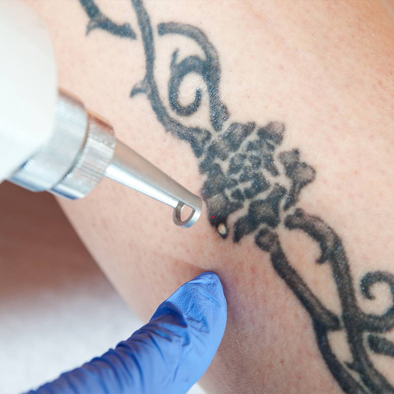 Close-up of laser tattoo removal on a person’s arm with blue-gloved hand guiding.