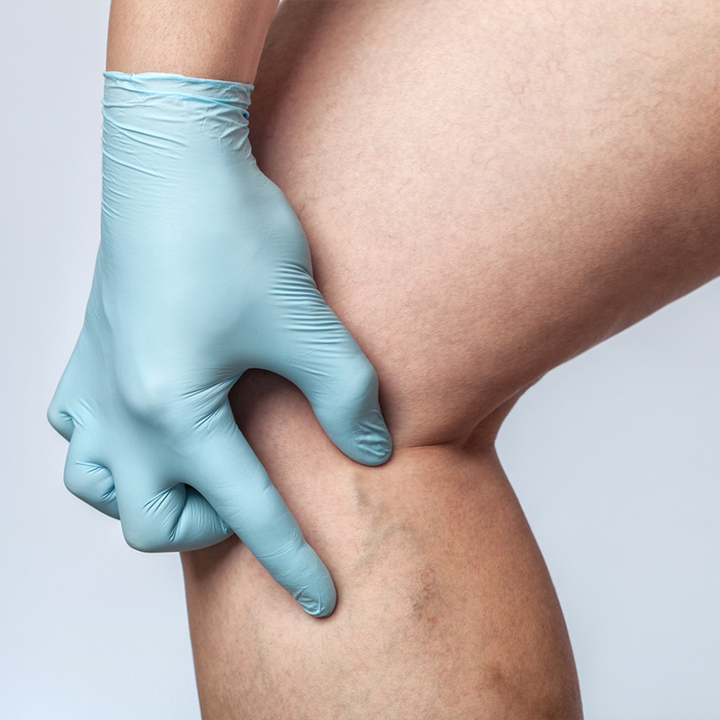 Gloved hand examining leg with varicose veins.
