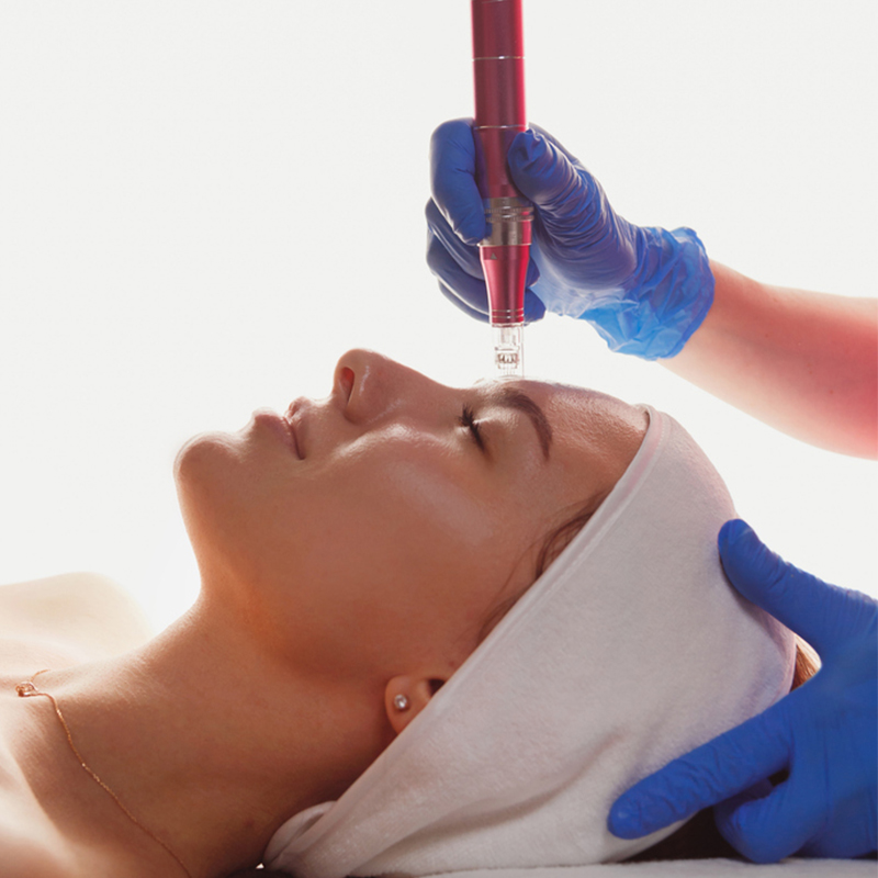 Woman receiving facial treatment with a microneedling device, close-up.