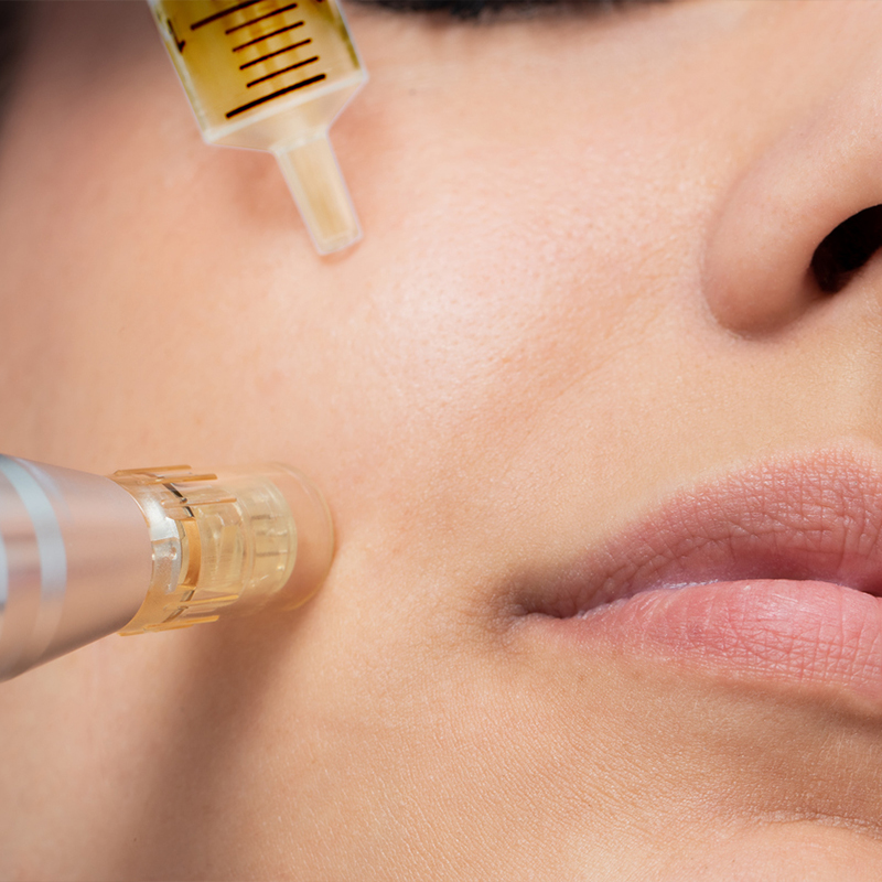 Close-up of a woman's face receiving a cosmetic treatment with two syringes.